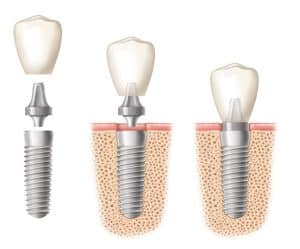 implantologie-dentaire-marseille